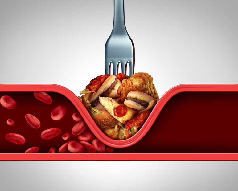 Heart disease resulting in blocked arteries