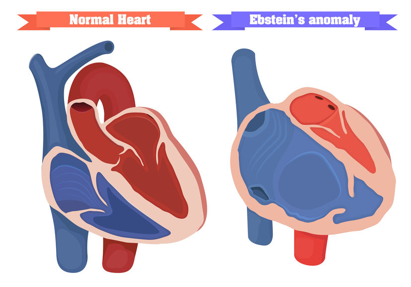 Ebstein anomaly congenital heart disease