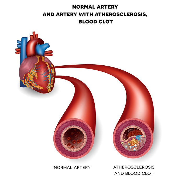 2 arteries showing blocked arteries from fatty ldl cholesterol