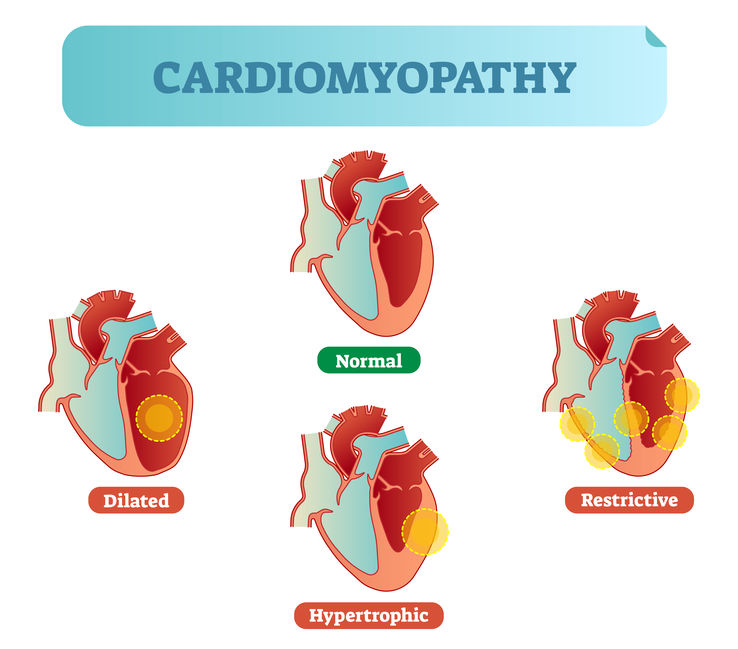 Different types of cardiomyopathy 