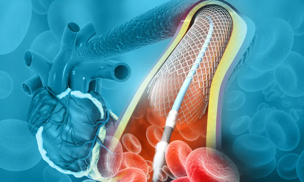 A clear angioplasty inserted with a stent