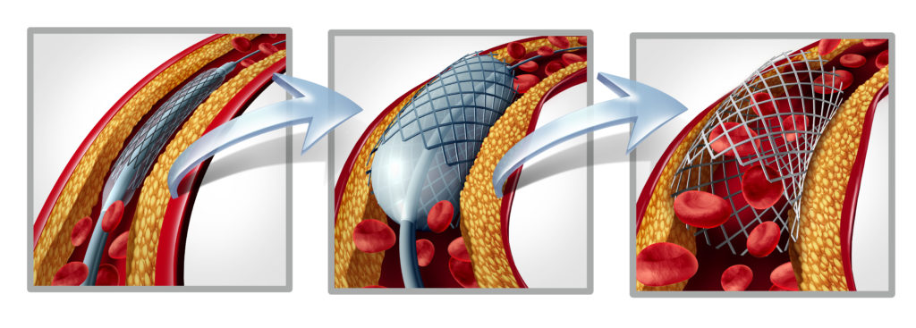 Treatment of coronary artery disease using a stent