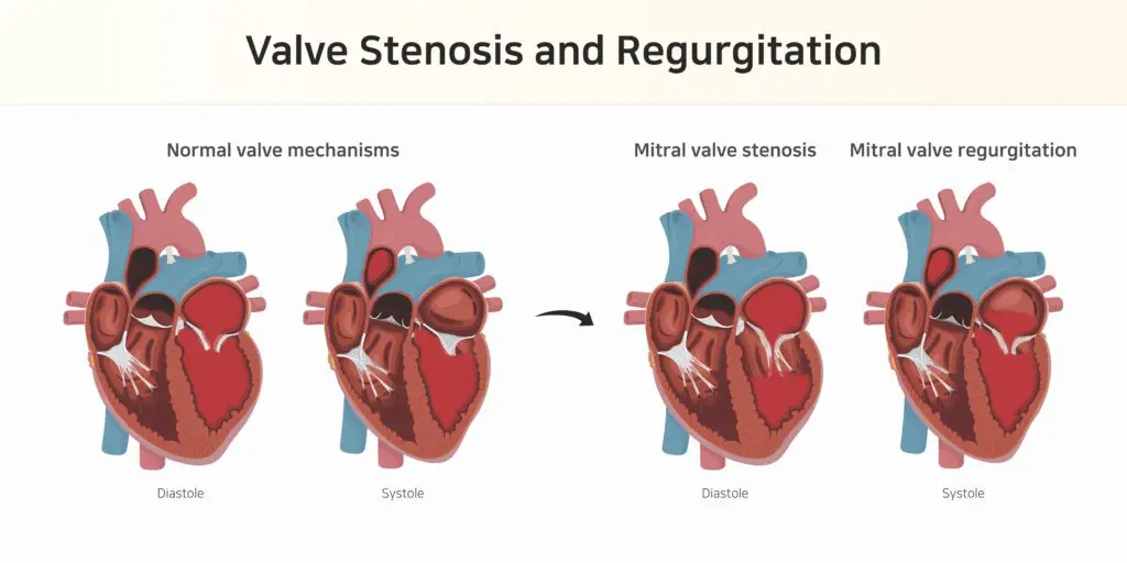 four different hearts displaying valvular heart disease