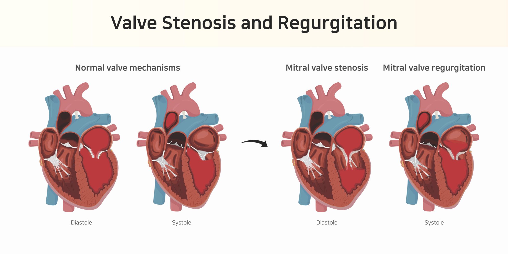 Valvular Heart Disease What are the different types Pulse Cardiology