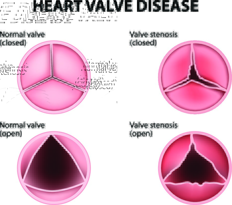 different types of valvular heart disease