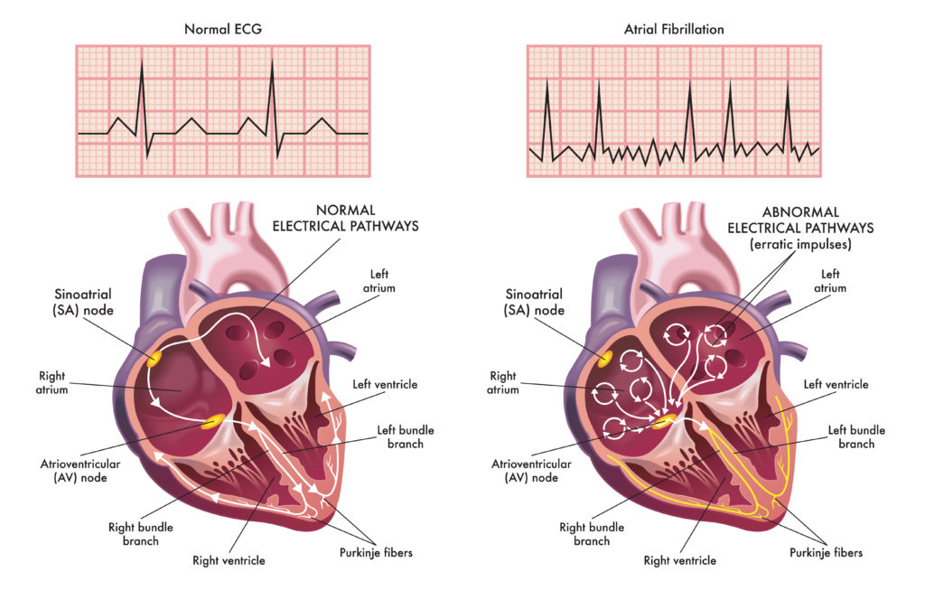 heart different between a normal ecg and an atrial fibrillation ecg