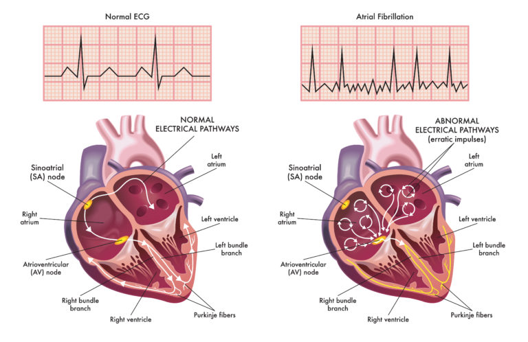difference between a flutter and afib