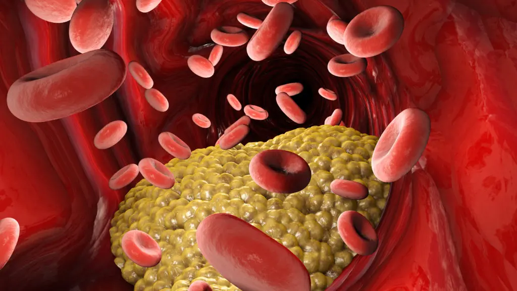Showing signs of high triglycerides and plaque in the artery