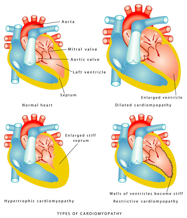 a graph showing the different types of cardiomyopathy