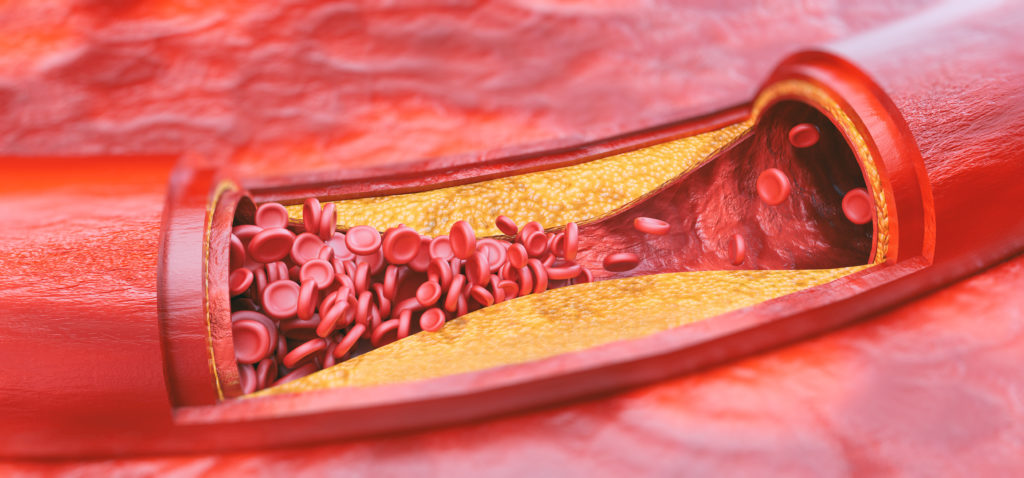 atherosclerosis showing signs of plaque in the artery