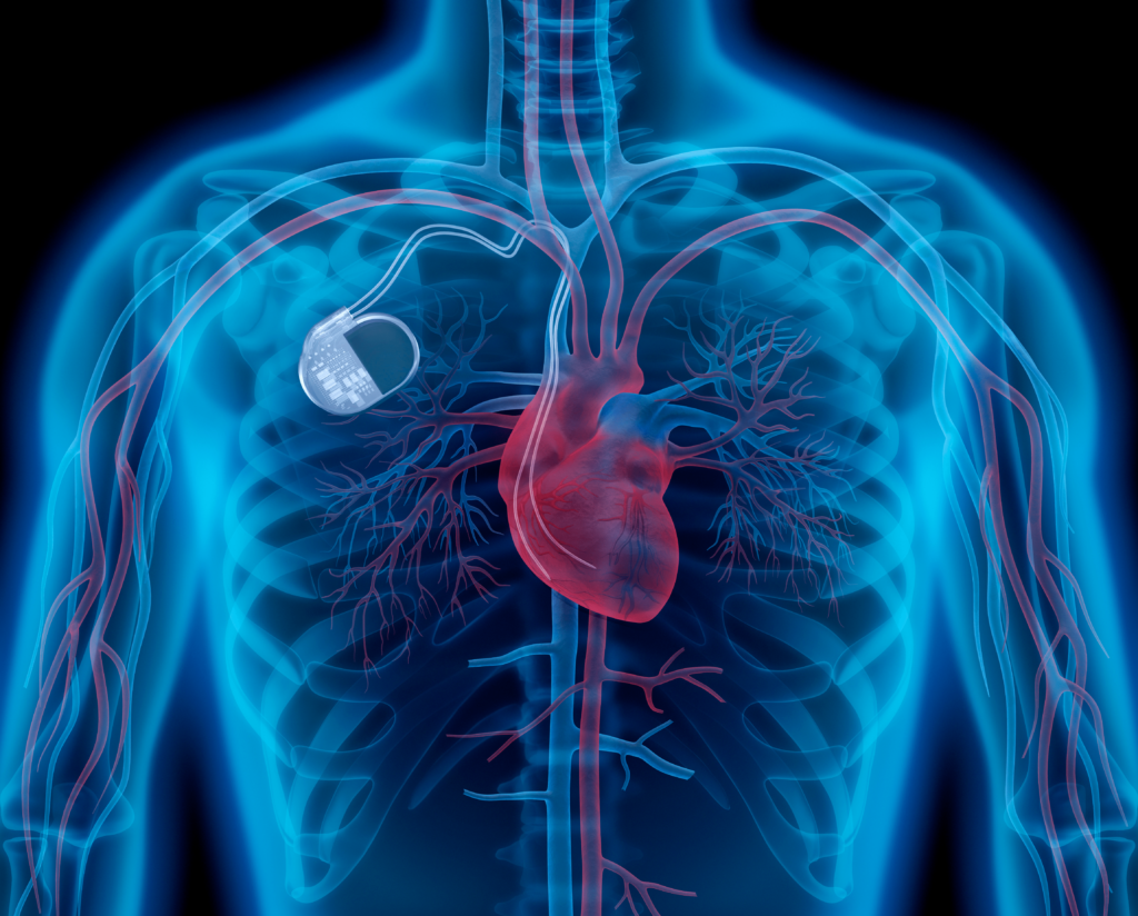 Types Of Pacemakers Pulse Cardiology