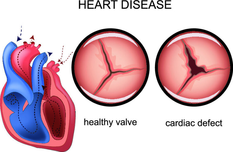 Mitral Valve Disease Symptoms And Treatment Pulse Cardiology