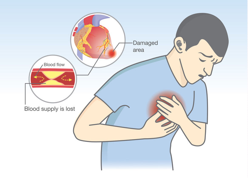 man have early symptoms of heart attack. blood flow get blocked by fatty which that is cause angina and heart attack.