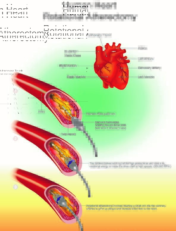 Atherectomy procedure through an artery