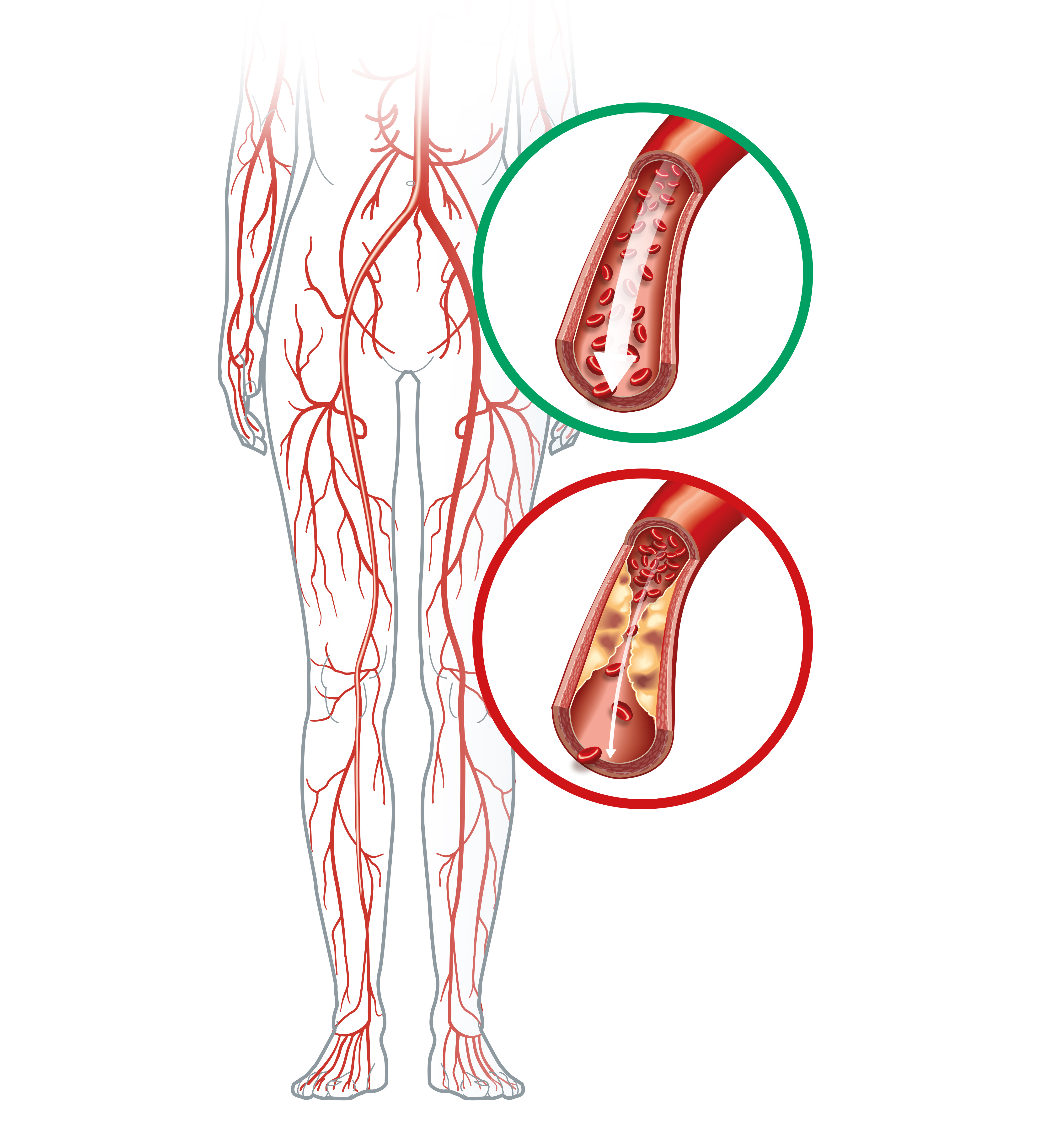 Illustration showing healthy artery and arterioslerotic artery, peripheral artery occlusive disease.