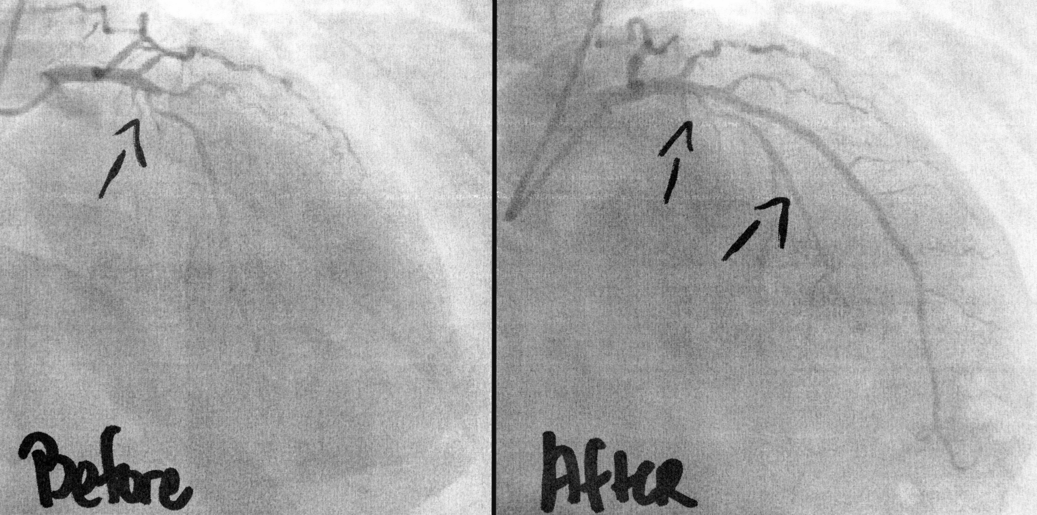 An image of a CT coronary angiogram