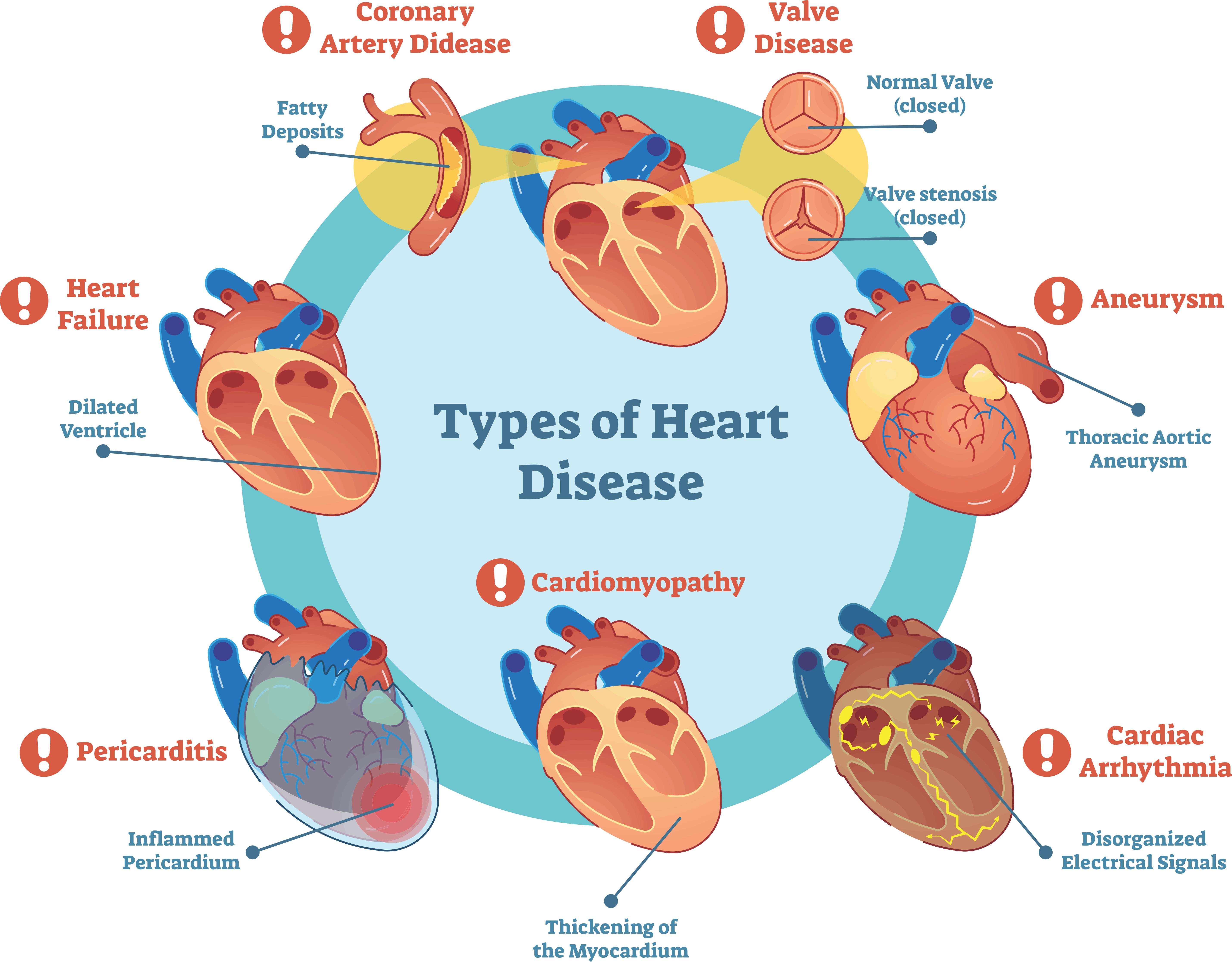 Coronary Artery Disease Symptoms