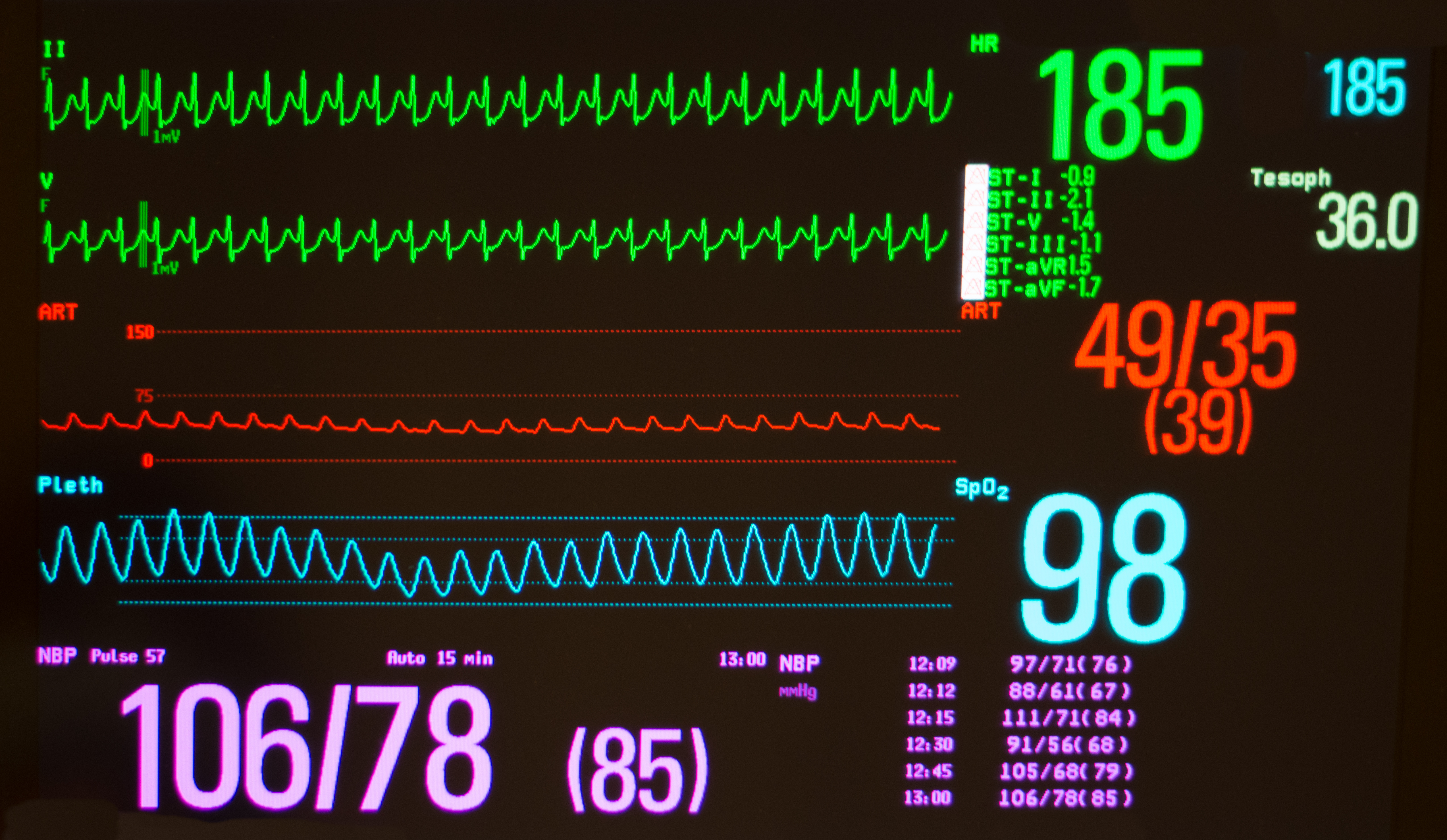 heart rate monitor showing signs of tachycardia